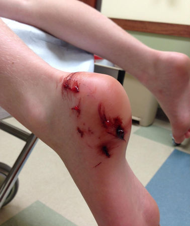 Shark Attacks Child in Lake Pontchartrain